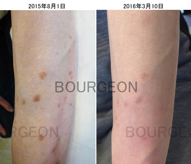 症例】シミ 40代 富士宮市｜腕と脚のシミが劇的改善 | ブルジョン